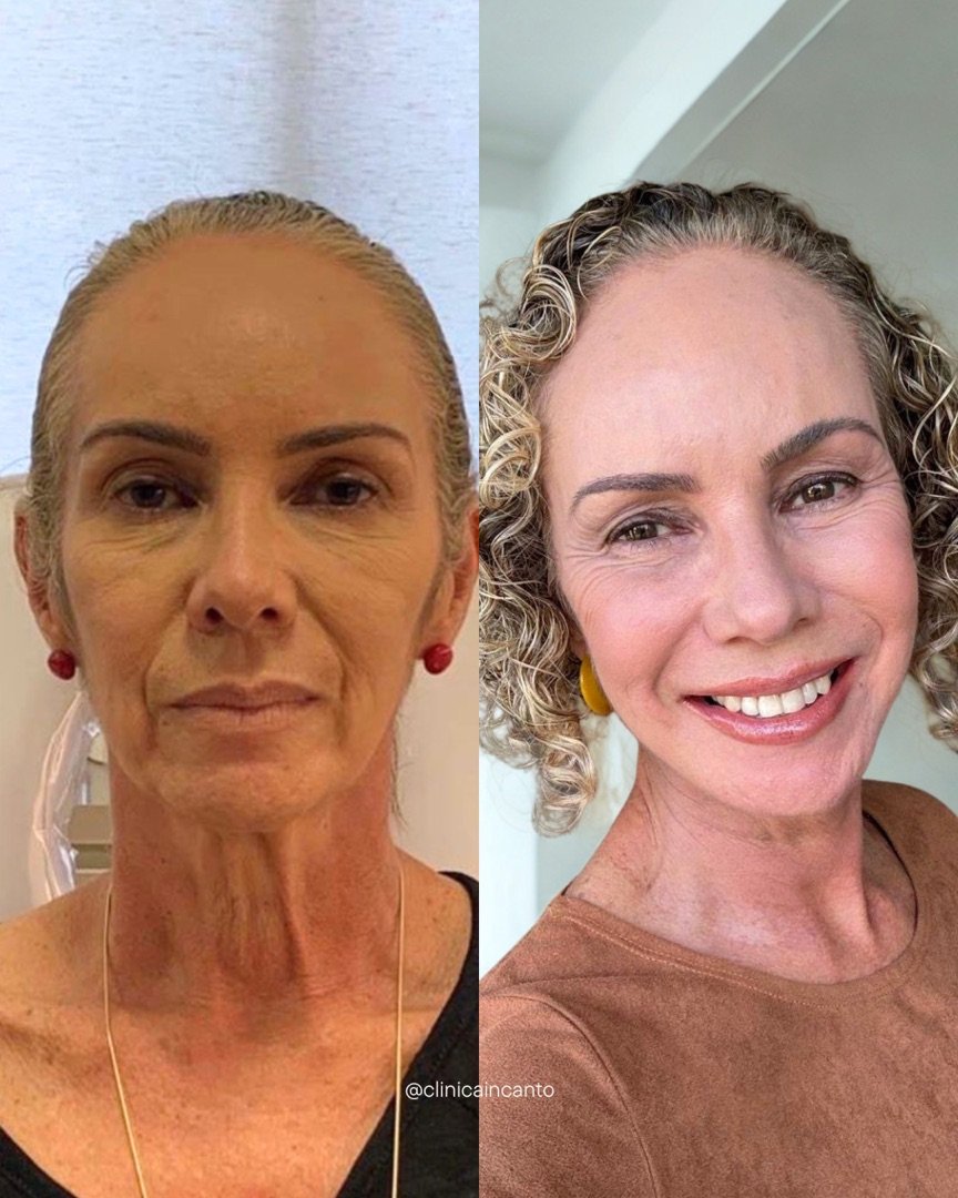 Paciente da Incanto, antes e depois do plano de harmonização facial.
