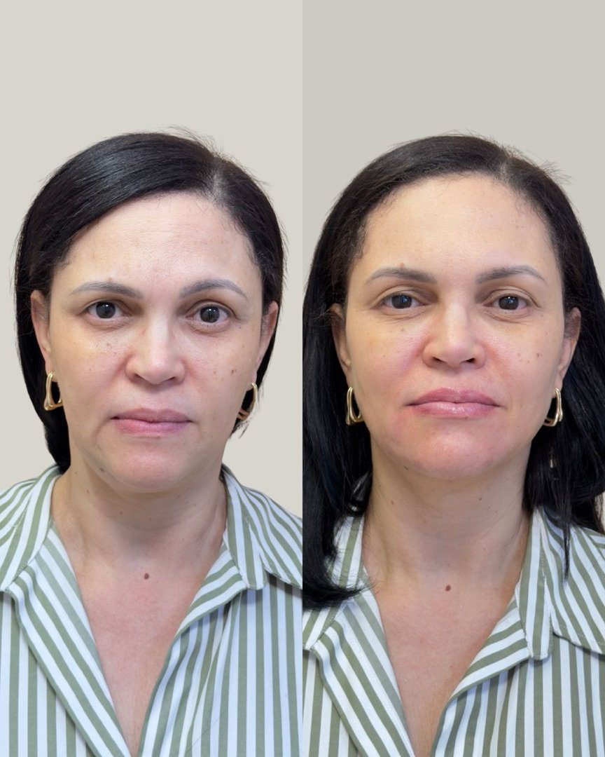 Paciente da Incanto, antes e depois do plano de harmonização facial.