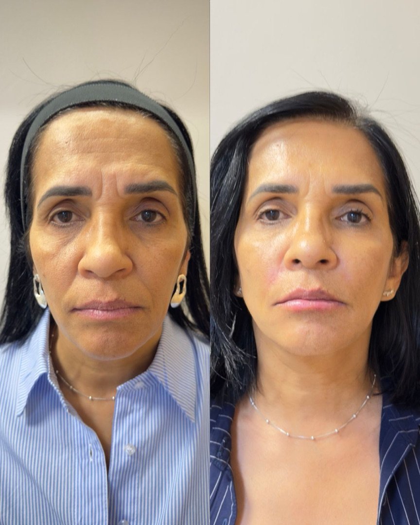 Paciente da Incanto, antes e depois do plano de harmonização facial.