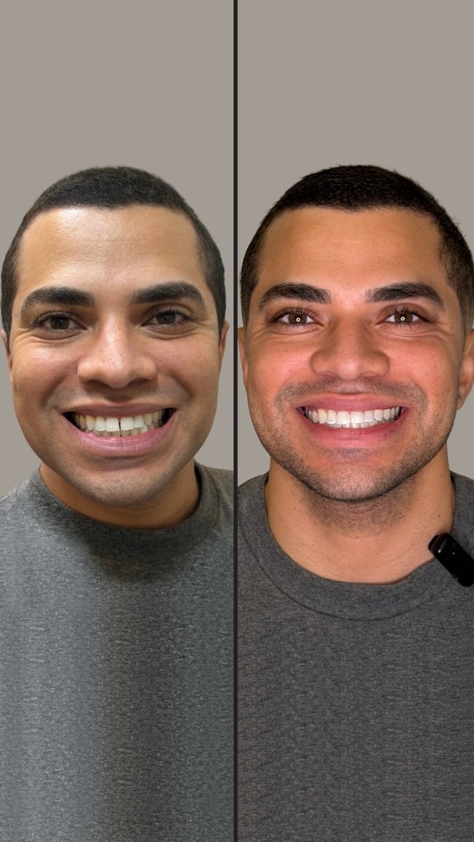 Paciente da Incanto. Forma e cor corrigidas mantendo a proporção do sorriso, sem aquele branco de vitrine.