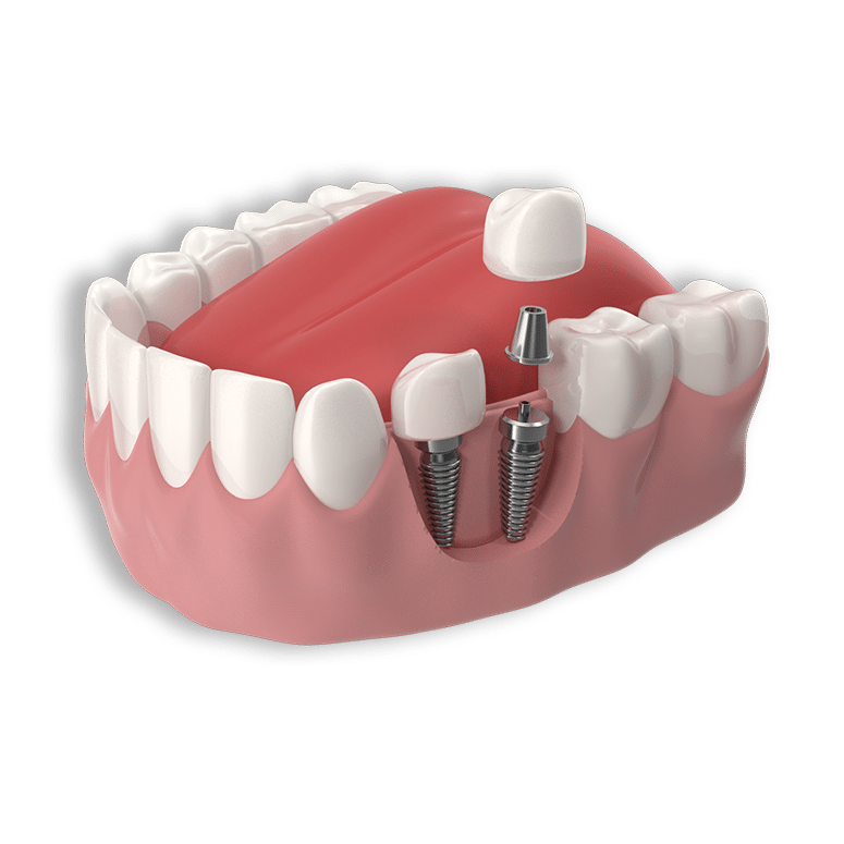 Implantes e próteses