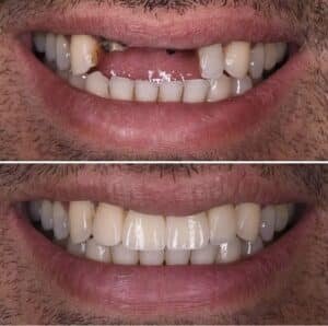 Sorriso com implante dentário – solução moderna para substituir dentes perdidos.