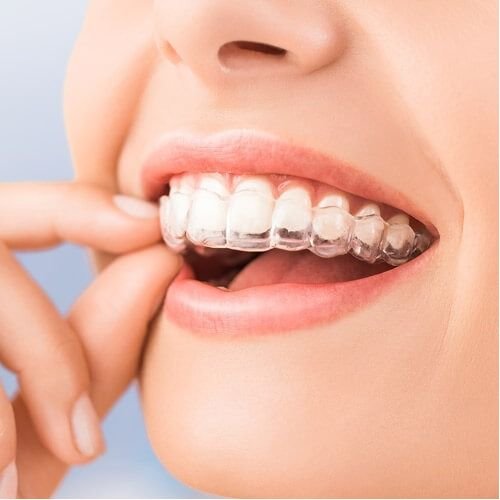 Invisalign