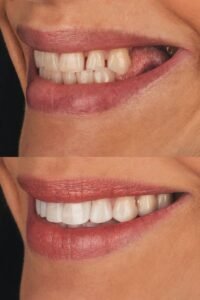 Sorriso com implante dentário-solução moderna para substituir dentes perdidos.