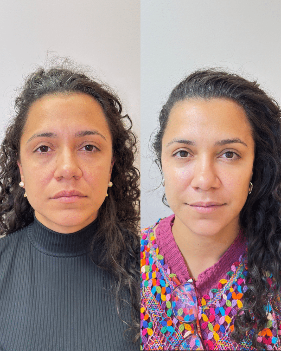 Olhar cansado, rugas marcando - MODE)L O(1)