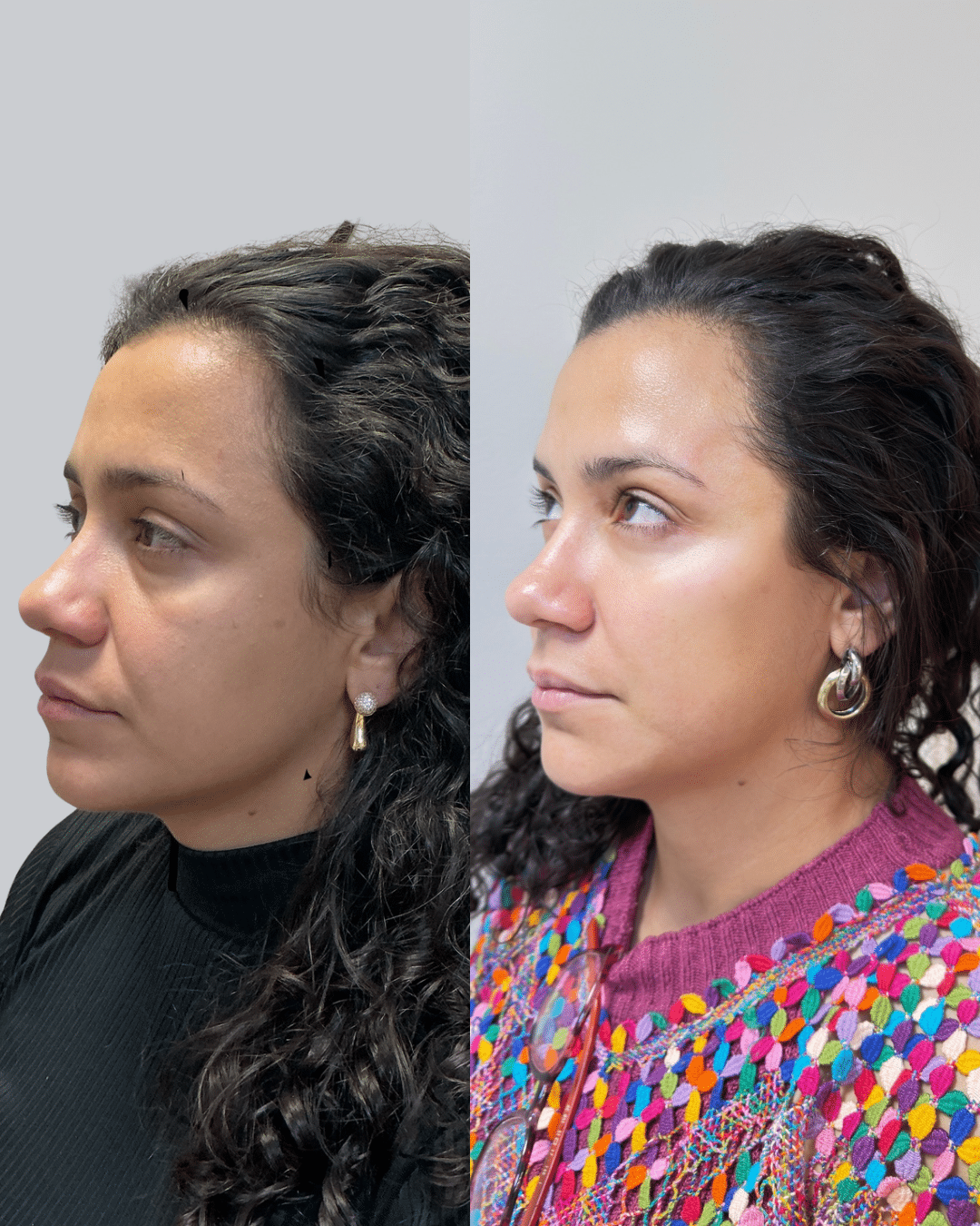 Olhar cansado, rugas marcando - MODELIO(1)