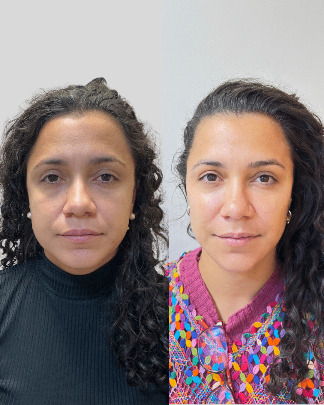 Olhar cansado, rugas marcando - MODEl)L O.